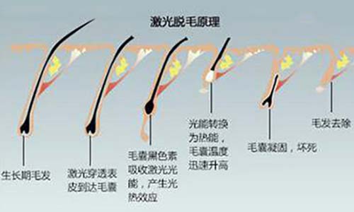 夏季脫毛：為什么有人說(shuō)光子脫毛沒(méi)有效果？(圖2)